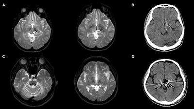 Deep brain stimulation in posterior subthalamic area for Holmes tremor: Case reports with review of the literature